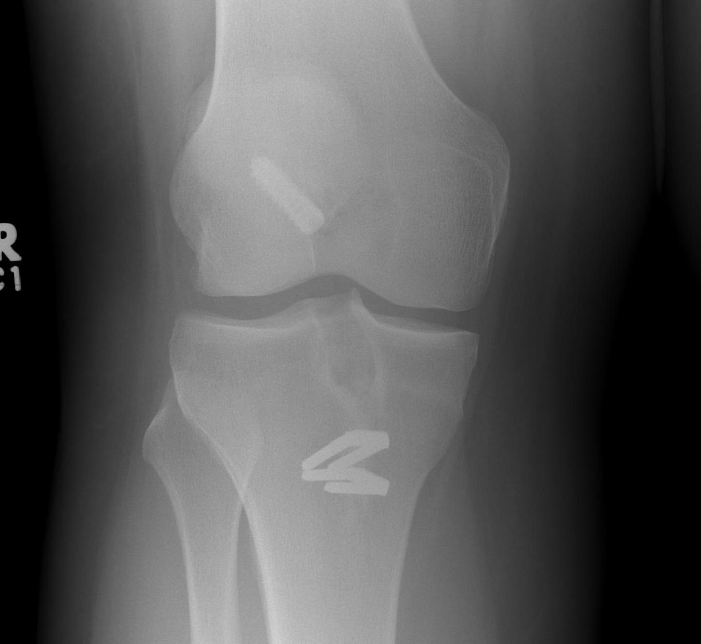 ACL BPTB Allograft AP